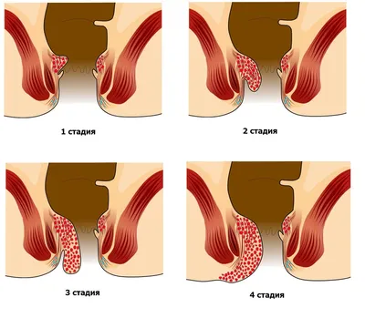 Боль в заднем проходе: симптомы, причины появления, диагностика, лечение -  Чемпионат