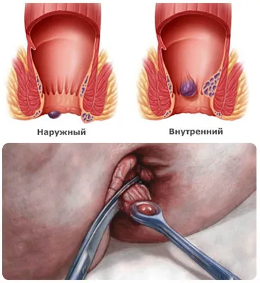 Surgeon Belkin Igor - Полипы и аденомы по своей сути являются опухолями  кишечника. Опухоль – это новообразованная ткань. Причиной возникновения  опухолей является генетическая патология, в результате которой в клетке  нарушается правильный и