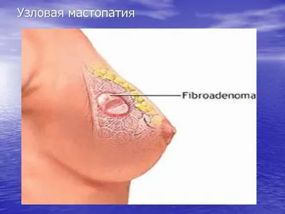 Рак прямой кишки: анализ на онкомаркеры, лечение и операции при разных  стадиях опухоли в Москве