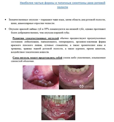 Папиллома полости рта - лечение: Стоматология Столица - Москва, проспект  Мира дом 12, стр. 3 (ЦАО)