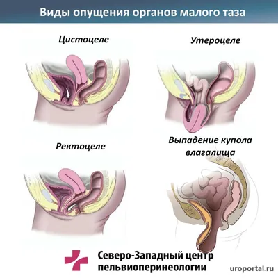 Опущение органов малого таза фото