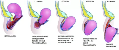 Physio Sapiens - ОПУЩЕНИЕ ОРГАНОВ МАЛОГО ТАЗА Пролапс... | Facebook