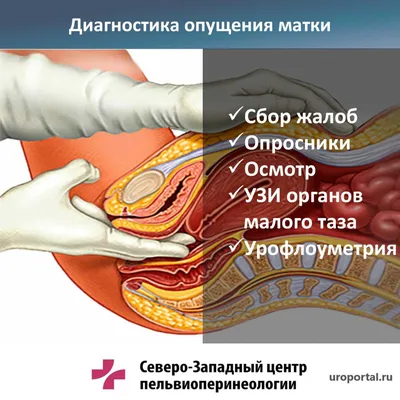 Пролапс тазовых органов