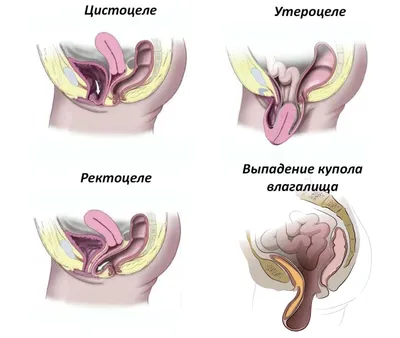 Цистоцеле: симптомы, диагностика, лечение, операция