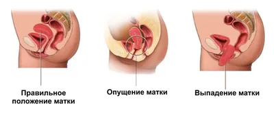 Опущение и выпадение органов малого таза: симптомы, лечение, операция