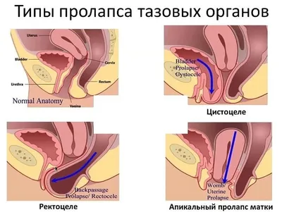 Пролапс гениталий — Клиника Ланцетъ