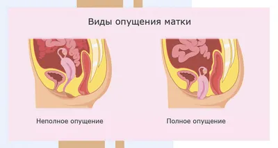 Опущение органов, слабые мышцы тазового дна. Комплекс упражнений в домашних  условиях - YouTube