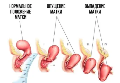 Пролапс: диагностика и лечение | ТС Клиника — г. Краснодар