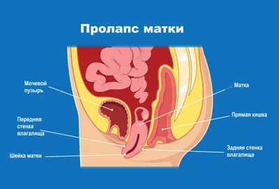 elvira_vagiton - Опущение органов малого таза ⠀ К сожалению, опущение  органов, достаточно частый диагноз у девушек после родов, а также  вследствие тяжелых физических нагрузок или прыжков на батуте. ⠀ В основном  врачи