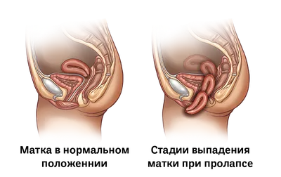Опущение и выпадение органов малого таза: симптомы, лечение, операция