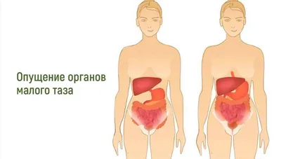 Фиксация матки при опущении, лечение - клиника Геном в Томске