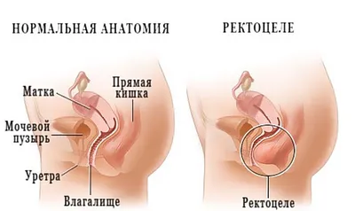 Ректоцеле – хирургическое лечение - Швейцарская Университетская Клиника