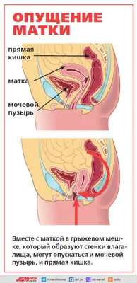 Не опуститься до предела. Как вылечить пролапс матки | Здоровая жизнь |  Здоровье | Аргументы и Факты