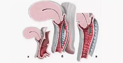 Задняя кольпорафия (ушивание задней стенки влагалища) в Москве | Техника  операции и цены в клинике профессора Блохина С.Н.