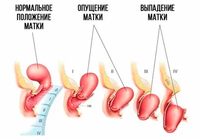 Опущение матки 2 степени - симптомы, лечение, операция. - Хирург К. В.  Пучков