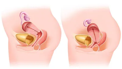 Опущение матки - причины, симптомы и лечение заболевания