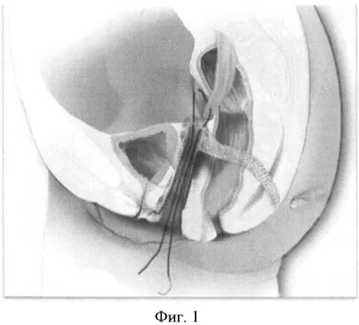 СПОСОБ ХИРУРГИЧЕСКОГО ЛЕЧЕНИЯ ОПУЩЕНИЯ ПЕРЕДНЕЙ СТЕНКИ ВЛАГАЛИЩА У ЖЕНЩИН С  ВЫСОКИМ РИСКОМ РЕЦИДИВА ПОСЛЕ ЭКСТИРПАЦИИ МАТКИ. Патент № RU 2499570 МПК  A61B17/42 | Биржа патентов - Московский инновационный кластер