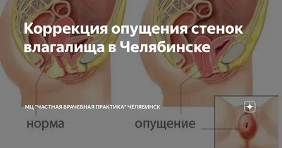 Коррекция опущения стенок влагалища в Челябинске | МЦ \"Частная врачебная  практика\" Челябинск | Дзен