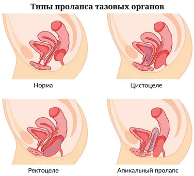 Пролапс тазовых органов — лечение, причины, симптомы и диагностика