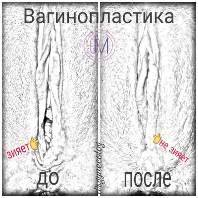 Лечение опущения влагалища в Запорожье: стоимость операции и ее особенности