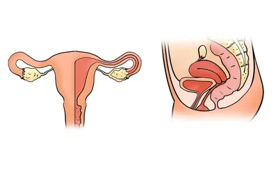 Опущение тазовых органов - как проявляется, диагностика, лечение