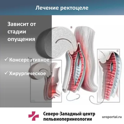 Пролапс (опущение матки и стенок влагалища) / Болезни / Лапароскопия в  Воронеже