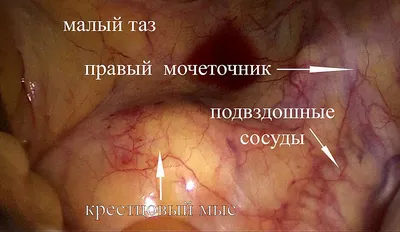 Пролапс (опущение матки и стенок влагалища) / Болезни / Лапароскопия в  Воронеже