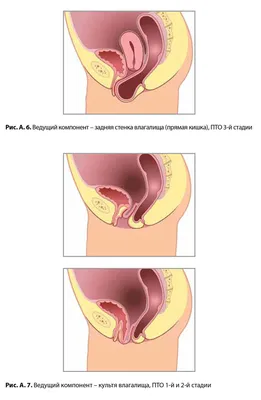 Лечение опущения передней стенки влагалища