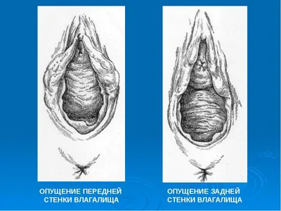 Хирургия влагалища, цена в СПб