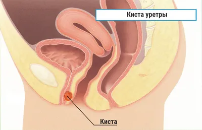 Опущение задней стенки влаг фото