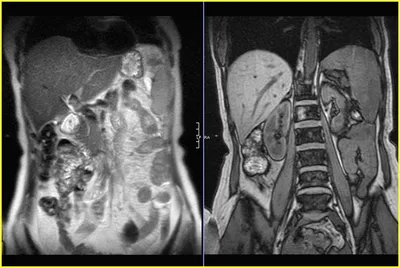 МРТ органов брюшной полости - МРТ Центр ООО \"ВМТ\"