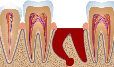 Как восстановить зуб если остался только один корень | Альянс  бьюти-ортопедов, Москва