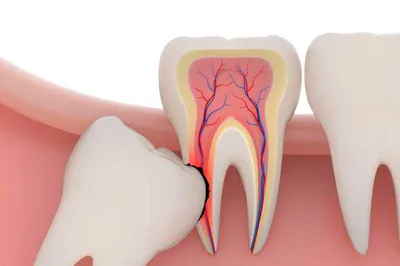 Удаление корня зуба: особенности операции и возможные осложнения -  Стоматология ЭспаДент