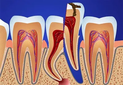 Удаление корня зуба в Уфе | Стоматологическая клиника «Маэстро»
