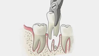 Долго болит десна после удаления зуба (Москва) - Профессиональный  стоматологический портал (сайт) «Клуб стоматологов»