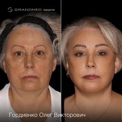 Deep Plane Facelift - новый в России метод подтяжки лица и шеи. Почему это  лучше SMAS-лифтинга? | Пластический хирург Гордиенко ОВ | Дзен