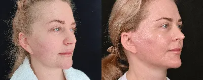 Выпадение волос после подтяжки лица - Cosmetic-clinic