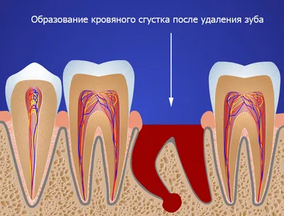 Что такое альвеолит зуба и как его лечить? | Silkdentist