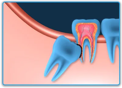 Удаление нижнего зуба мудрости [Цены, осложнения и уход после]