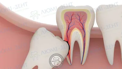 Осложнения после удаления зуба мудрости