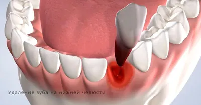 ПРОФИЛАКТИКА ОСЛОЖНЕНИЙ ПОСЛЕ УДАЛЕНИЯ ЗУБА | Областная больница № 23 (г.  Ялуторовск) | Дзен