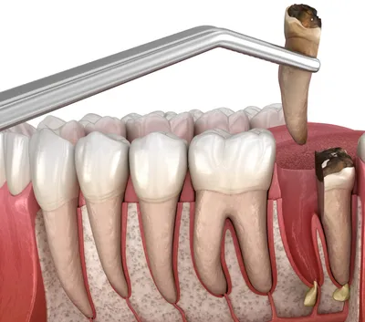 Операция Удаления Зуба-Местные Осложнения После Удаления Зуба