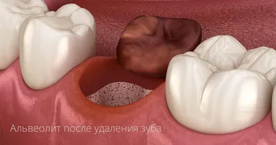 Киста после удаления зуба: кто виноват и как лечить заболевание | Dental Art