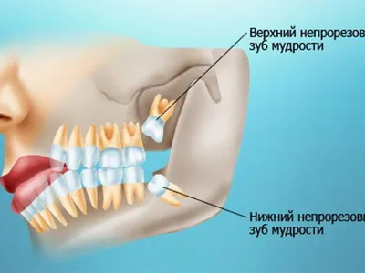 🇺🇦 Осложнения после удаления зуба, какие бывают и почему - YouTube