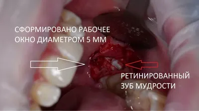 Атравматичное удаление зубов мудрости. Правила и рекомендации.