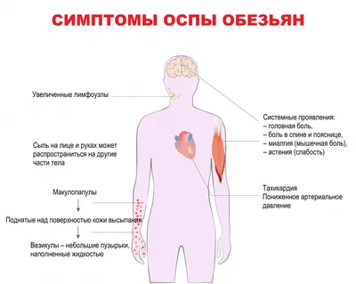 Обезьянья оспа - причины появления, симптомы заболевания, диагностика и  способы лечения