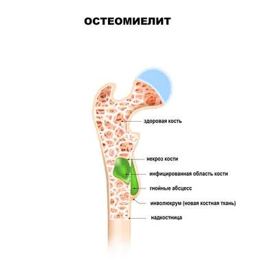 Остеомиелит фото