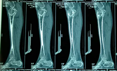 Остеомиелит, причины, симптомы, лечение | MedKontrol Маріуполь