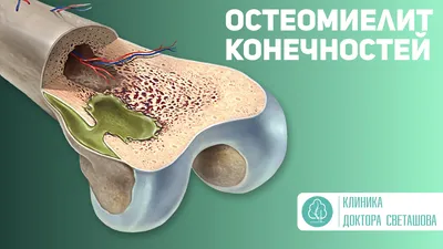 Клиника доктора Светашова - Остеомиелит конечностей