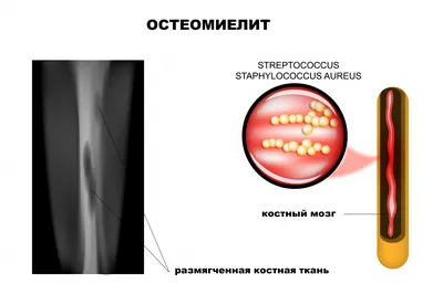 Остеомиелит - причины появления, симптомы заболевания, диагностика и  способы лечения